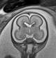 File:Normal brain fetal MRI - 22 weeks (Radiopaedia 50623-56050 Coronal T2 Haste 13).jpg