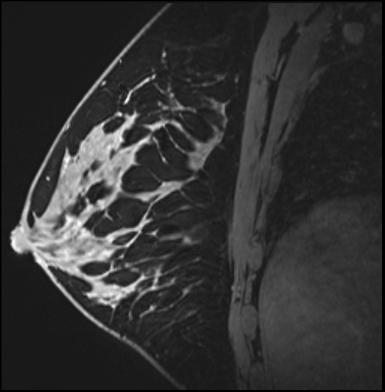 Normal breast MRI - dense breasts (Radiopaedia 80454-93850 I 111).jpg
