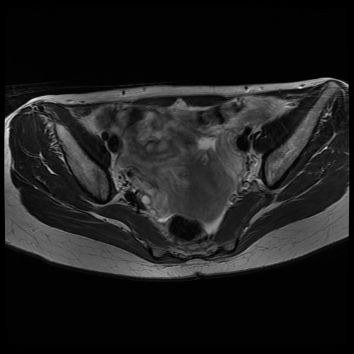 File:Normal female pelvis MRI (retroverted uterus) (Radiopaedia 61832-69933 Axial T2 15).jpg