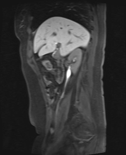 File:Normal hepatobiliary phase liver MRI (Radiopaedia 58968-66230 C 27).jpg