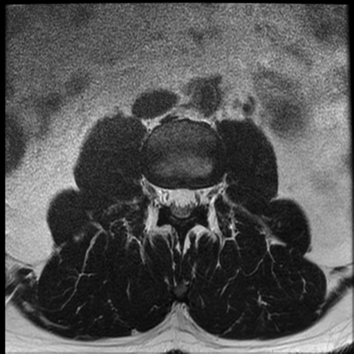 File:Normal lumbar spine MRI (Radiopaedia 35543-37039 Axial T2 28).png
