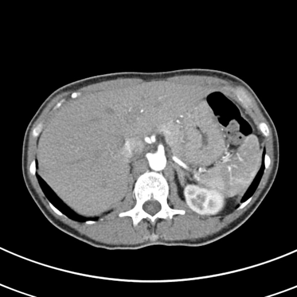 File:Normal multiphase CT liver (Radiopaedia 38026-39996 B 18).jpg