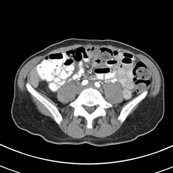 File:Normal multiphase CT liver (Radiopaedia 38026-39996 B 58).jpg