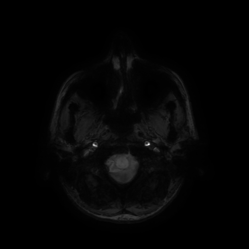 Normal noncontrast MR venography (Radiopaedia 87578-103957 Axial SWI 70).jpg