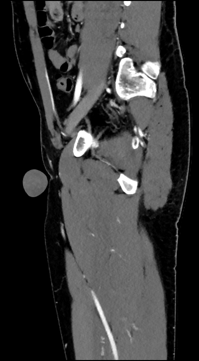 Normal pelvis CT angiogram (Radiopaedia 84966-100481 C 70).jpg
