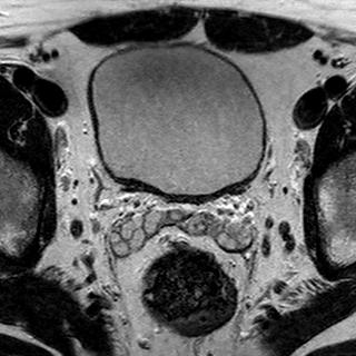 File:Normal prostate (MRI) (Radiopaedia 29986-30535 Axial T2 23).jpg