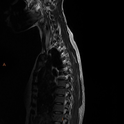 File:Normal spine MRI (Radiopaedia 77323-89408 E 3).jpg