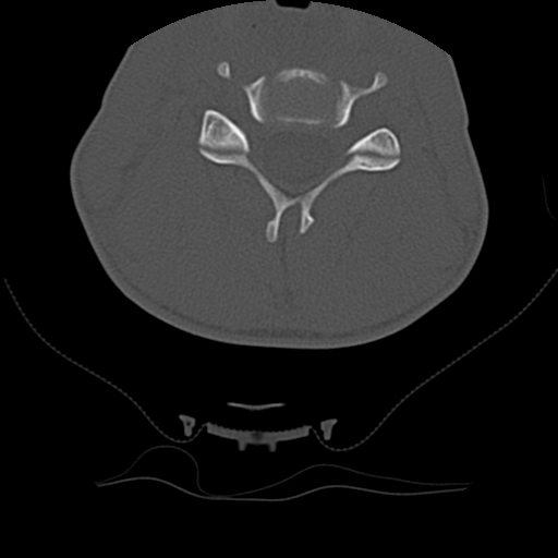 Normal trauma spine imaging (age 16) (Radiopaedia 45335-49358 Axial bone window 42).jpg