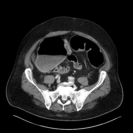 Obstructing sigmoid adenocarcinoma (Radiopaedia 58465-65619 A 119).jpg