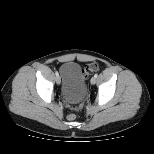 File:Obstructing ureteric calculus (Radiopaedia 18615-18514 B 49).jpg