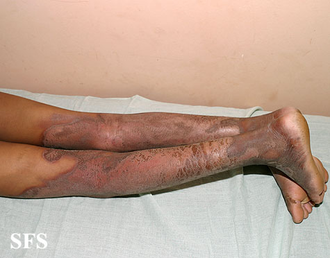 File:Pellagra (Dermatology Atlas 42).jpg