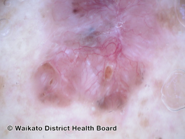 File:Polarised dermoscopy of pigmented basal cell carcinoma (DermNet NZ polarised-dermoscopy-bcc).jpg
