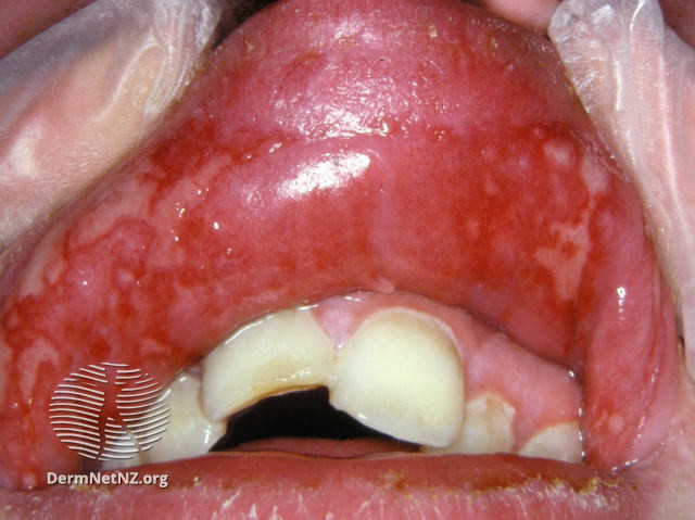 File:(DermNet NZ herpes-simplex-labialis-32).jpg