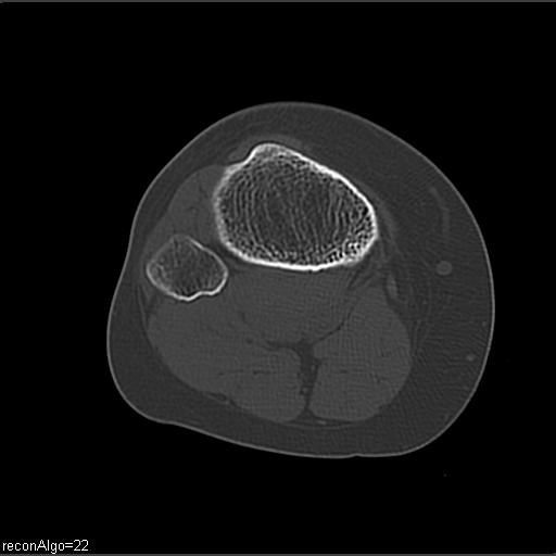 File:ACL avulsion fracture (Radiopaedia 33833-34994 Axial bone window 23).jpg