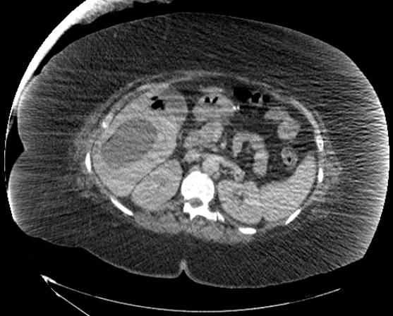 File:Abdominal abscess - pre and post percutaneous drainage (Radiopaedia 60209-67816 Axial 47).png