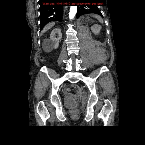 Abdominal aortic aneurysm- extremely large, ruptured (Radiopaedia 19882-19921 Coronal C+ arterial phase 72).jpg