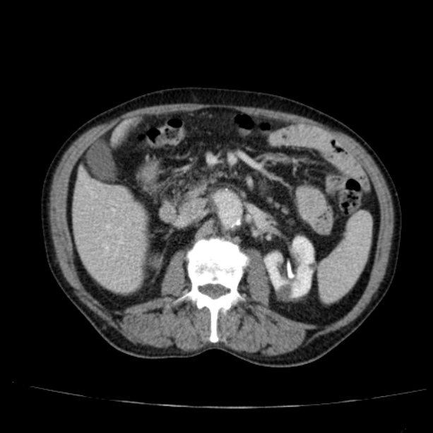 Abdominal aortic aneurysm (Radiopaedia 29248-29660 Axial C+ portal venous phase 25).jpg