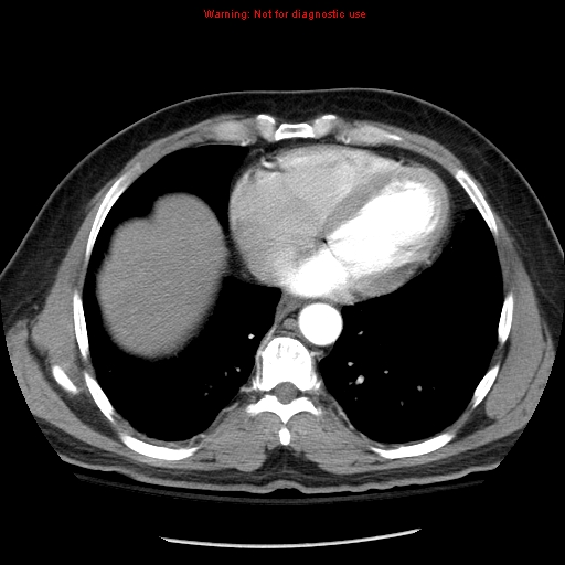 File:Abdominal aortic aneurysm (Radiopaedia 8190-9038 Axial C+ arterial phase 4).jpg