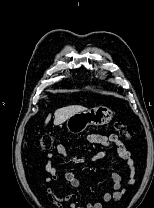 Abdominal aortic aneurysm (Radiopaedia 83094-97462 Coronal renal cortical phase 20).jpg