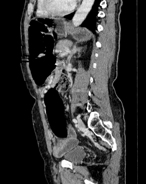 Abdominal aortic aneurysm (Radiopaedia 83581-98689 Sagittal C+ portal venous phase 75).jpg