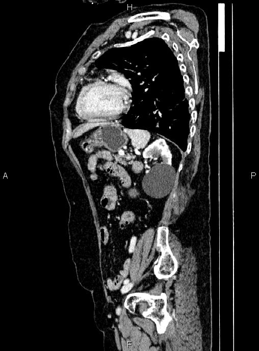 Abdominal aortic aneurysm (Radiopaedia 85063-100606 Sagittal C+ arterial phase 60).jpg