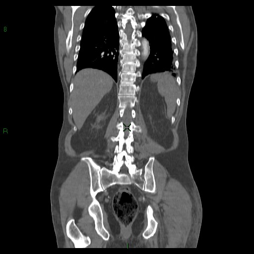 File:Abdominal aortic aneurysm rupture with aortocaval fistula (Radiopaedia 14897-14841 Coronal C+ arterial phase 33).jpg