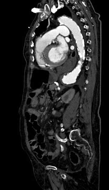 Abdominal aortic aneurysm with thrombus fissuration (Radiopaedia 73192-83919 Sagittal C+ arterial phase 51).jpg