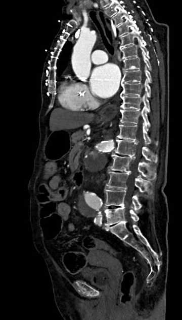 Abdominal aortic aneurysm with thrombus fissuration (Radiopaedia 73192-83919 Sagittal C+ arterial phase 69).jpg