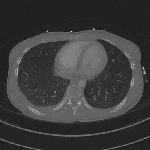 Abdominal multi-trauma - devascularised kidney and liver, spleen and pancreatic lacerations (Radiopaedia 34984-36486 I 61).png