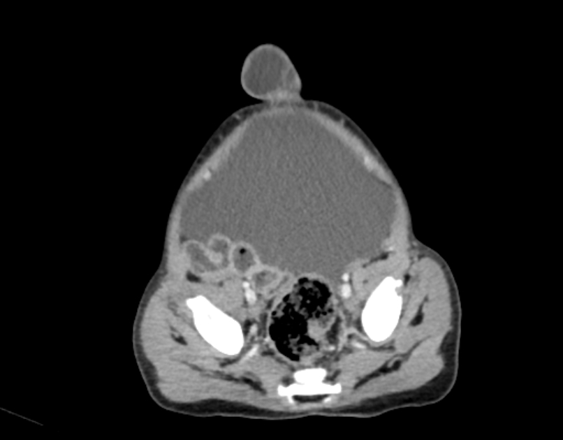 Abdominal premesenteric cystic lymphangioma (Radiopaedia 82995-97350 Axial C+ portal venous phase 56).jpg