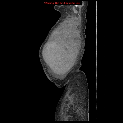 Abdominal wall hematoma (Radiopaedia 9427-10112 Sagittal C+ portal venous phase 105).jpg