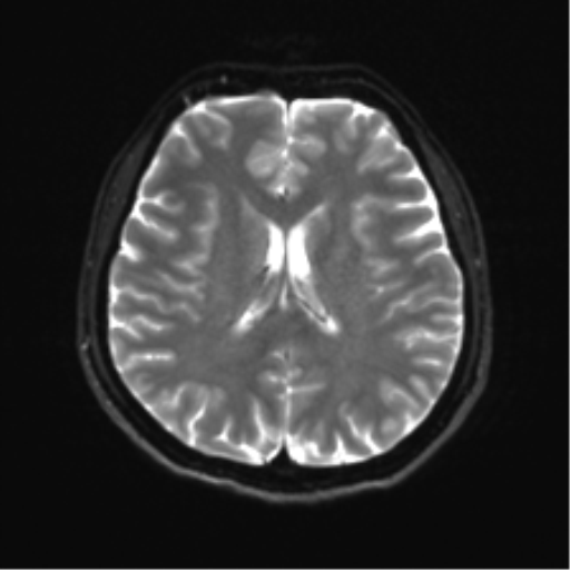 File:Abducens nerve palsy (Radiopaedia 51069-56648 Axial DWI 16).png