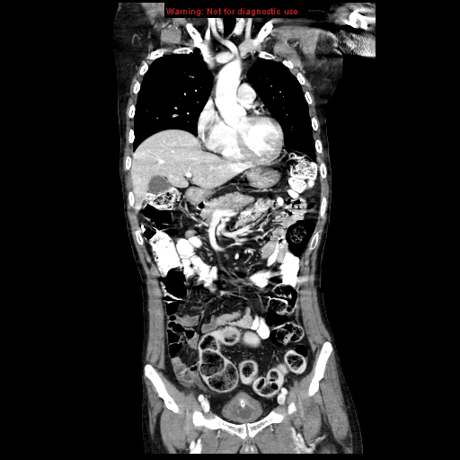 File:Aberrant right subclavian artery (Radiopaedia 9379-10071 Coronal C+ arterial phase 2).jpg