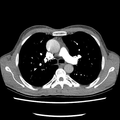 Accessory left horizontal fissure with lingular pneumonia (Radiopaedia 53763-59843 Axial C+ CTPA 39).jpg