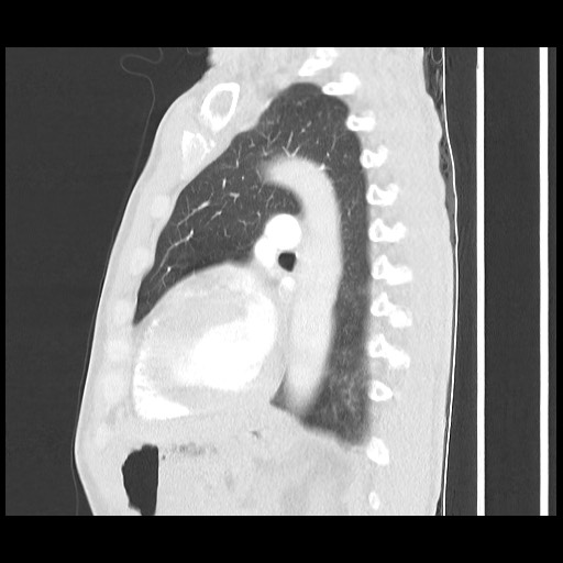 Accessory left horizontal fissure with lingular pneumonia (Radiopaedia 53763-59843 Sagittal lung window 43).jpg