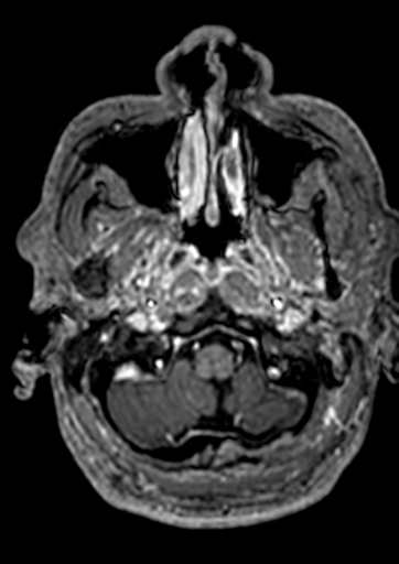 Accessory middle cerebral artery (Radiopaedia 73114-83828 Axial T1 C+ 175).jpg