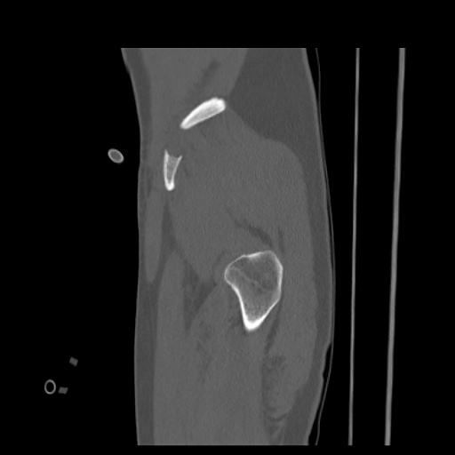 Acetabular and ilial fractures (Radiopaedia 59084-66378 Sagittal bone window 9).jpg
