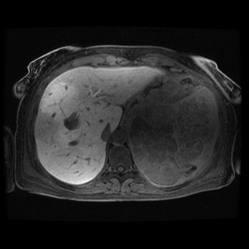 Acinar cell carcinoma of the pancreas (Radiopaedia 75442-86668 Axial late phase (~30 mins) 106).jpg