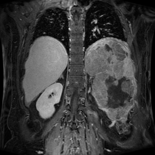 File:Acinar cell carcinoma of the pancreas (Radiopaedia 75442-86668 Coronal T1 C+ fat sat 57).jpg