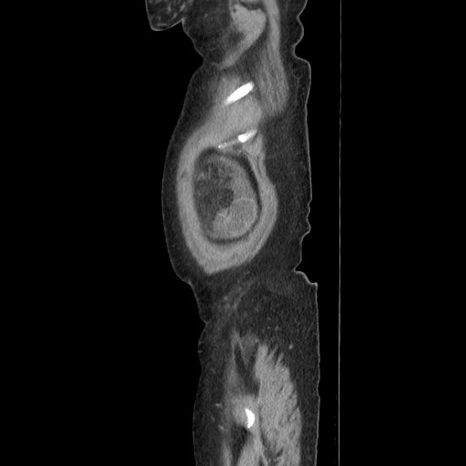 Acinar cell carcinoma of the pancreas (Radiopaedia 75442-86669 Sagittal C+ portal venous phase 27).jpg
