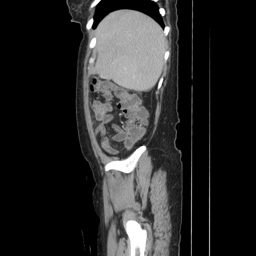Acinar cell carcinoma of the pancreas (Radiopaedia 75442-86669 Sagittal C+ portal venous phase 44).jpg