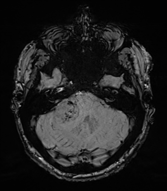 Acoustic schwannoma (Radiopaedia 50846-56358 Axial SWI 24).png