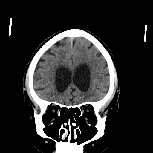 File:Acoustic schwannoma (Radiopaedia 55729-62280 Coronal non-contrast 13).png