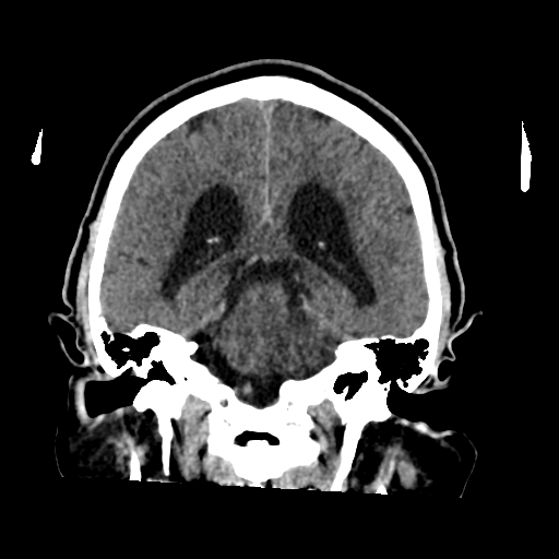 File:Acoustic schwannoma (Radiopaedia 55729-62280 Coronal non-contrast 26).png