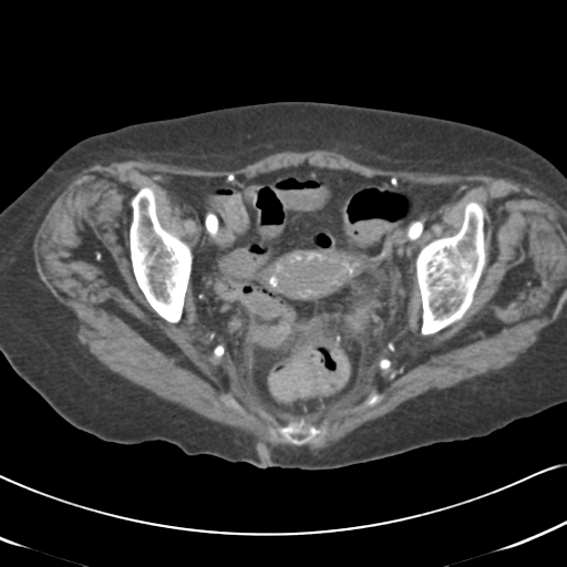 File:Active bleeding from duodenal ulcer with embolization (Radiopaedia 34216-35481 Axial C+ arterial phase 58).png