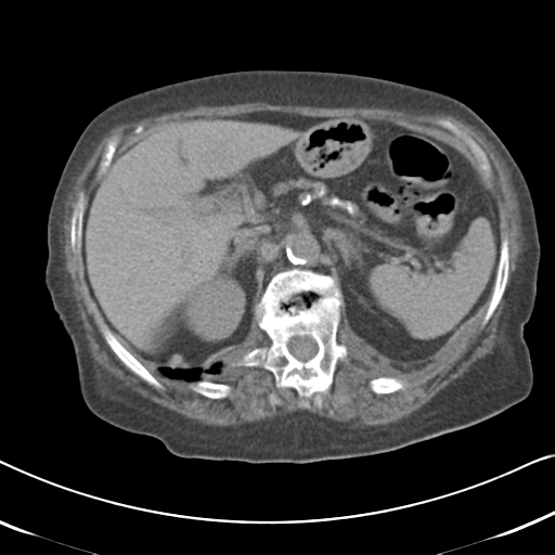 Active bleeding from duodenal ulcer with embolization (Radiopaedia 34216-35481 Axial non-contrast 21).png