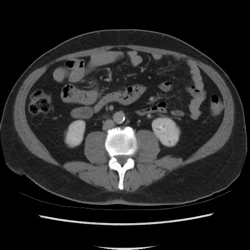 File:Active colonic bleed on CT (Radiopaedia 49765-55025 Axial C+ delayed 44).jpg