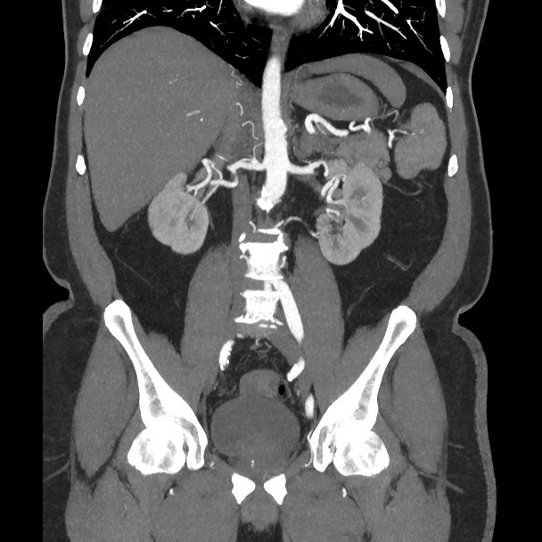 Active colonic bleed on CT (Radiopaedia 49765-55025 Coronal art MIP 36).jpg