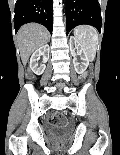 Active crohn disease (Radiopaedia 87133-103397 Coronal C+ arterial phase 45).jpg