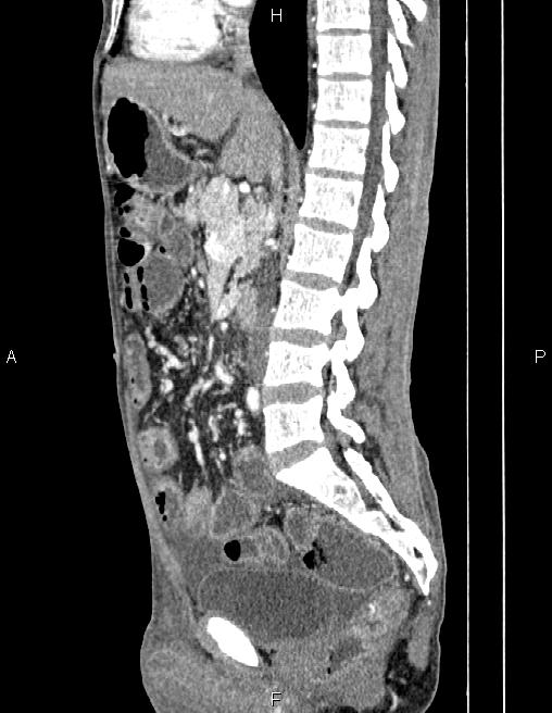 Active crohn disease (Radiopaedia 87133-103397 Sagittal C+ arterial phase 43).jpg